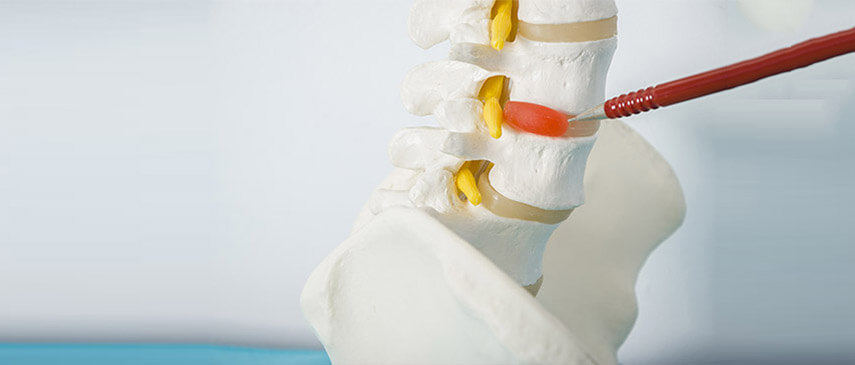 herniated disc