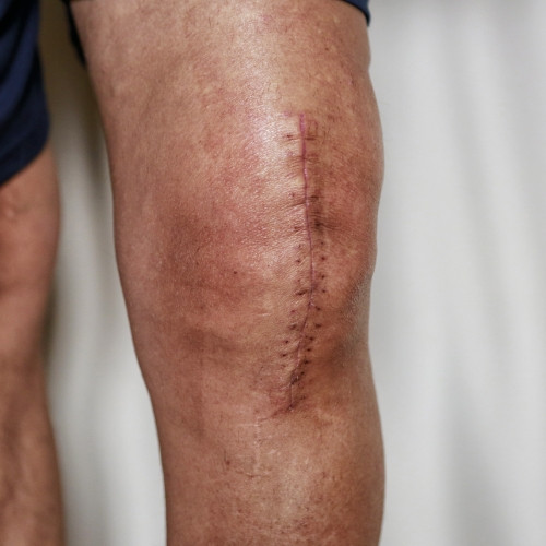 ACL-Knee-Replacement-MMA-&-Sports-Rehab-Arlington-VA