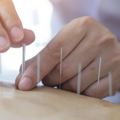 dry-needling-MMA-&-Sports-Rehab-Arlington-VA
